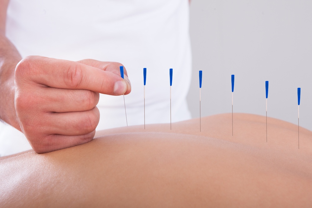 Acupuncture of the Spine
