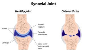 Osteoarthritic Joint