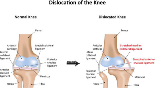 discolated knee