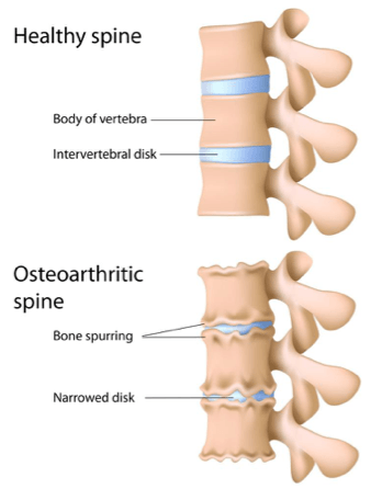 osteoarthritis