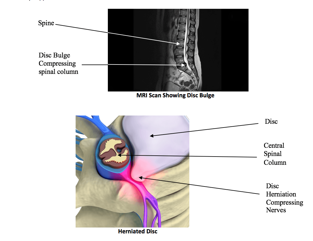 physiotherapy spinal disk bulge