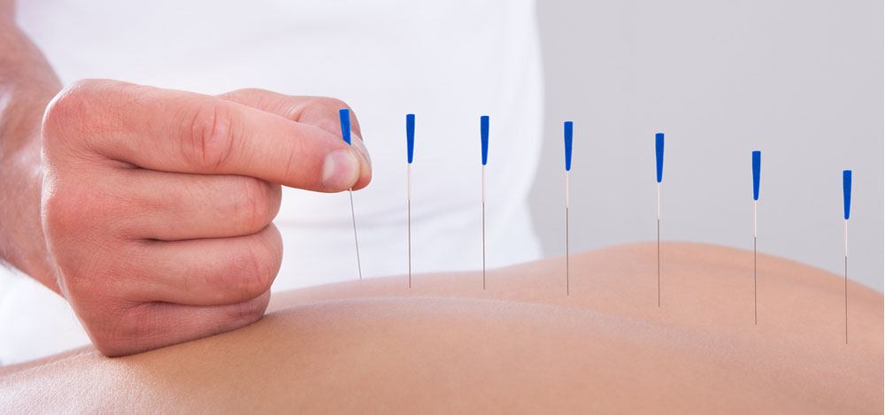 acupuncture stafford