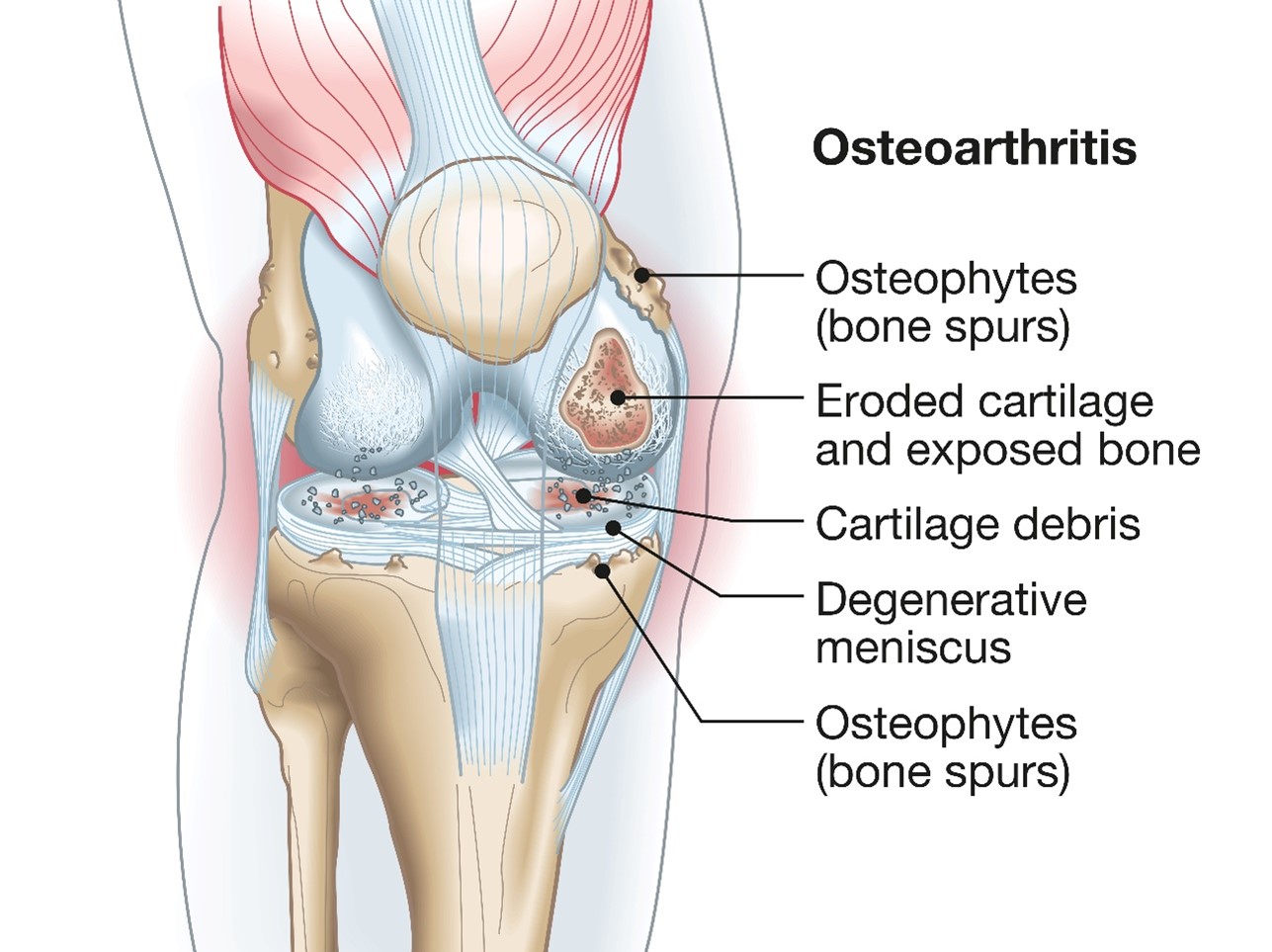 Osteo Osteo