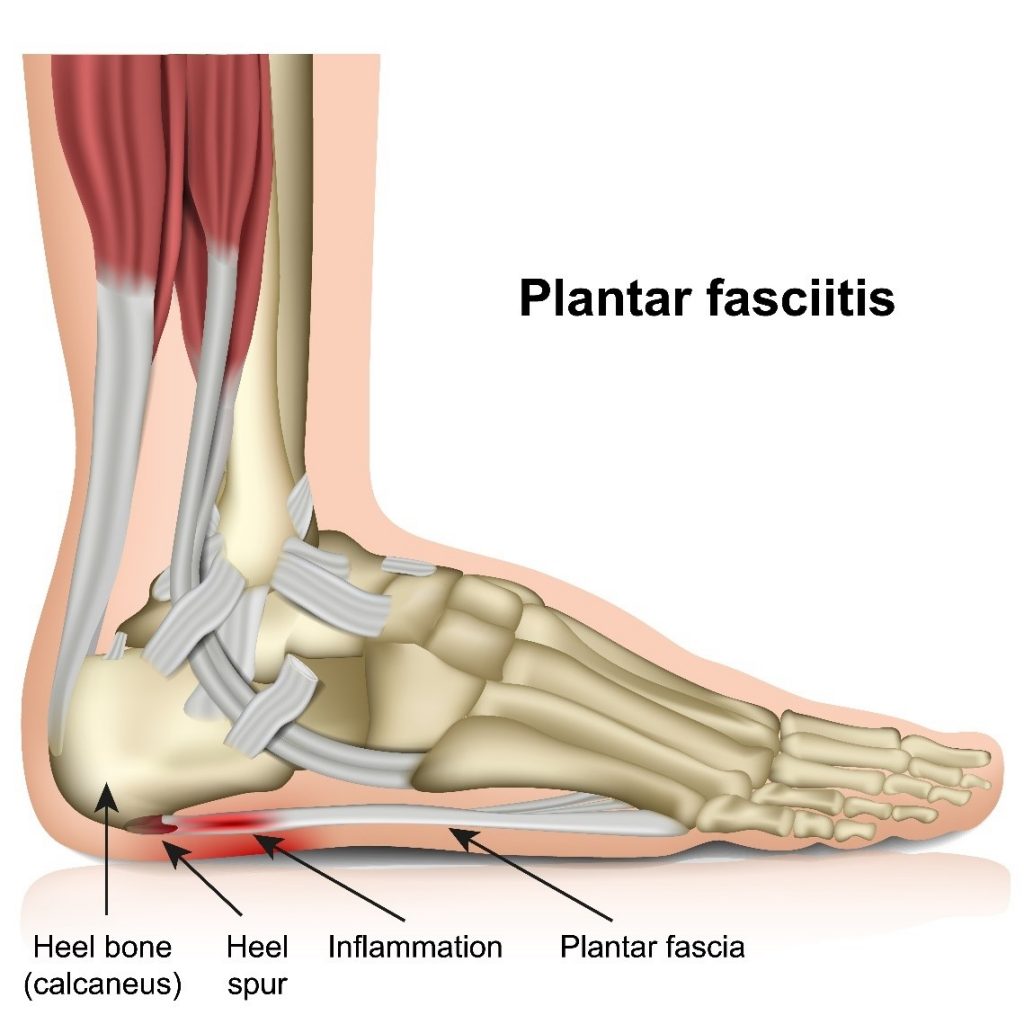 Plantar2 Plantar2