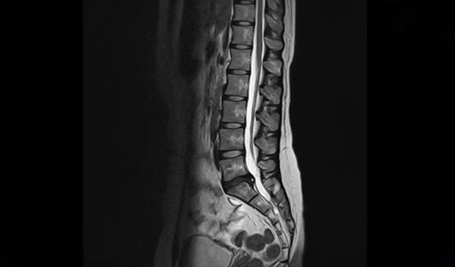 spinal disc