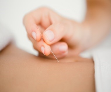 acupuncture