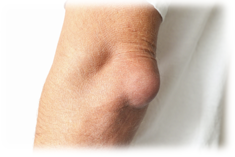 Bursitis of the elbow 