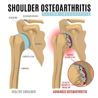 shoulder-osteoarthritis